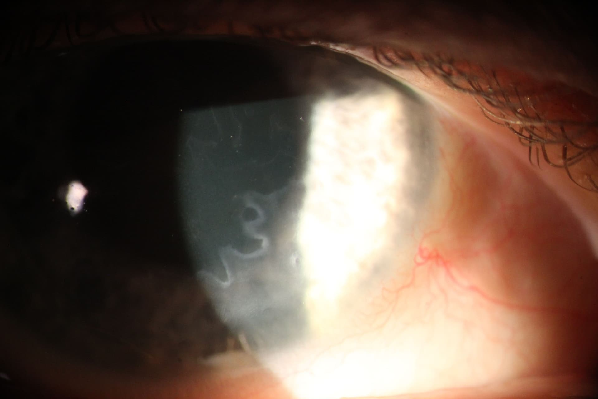 Slit lamp photograph of anterior basement membrane dystrophy (ABMD).