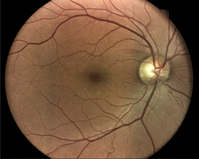 Baseline Fundus OD