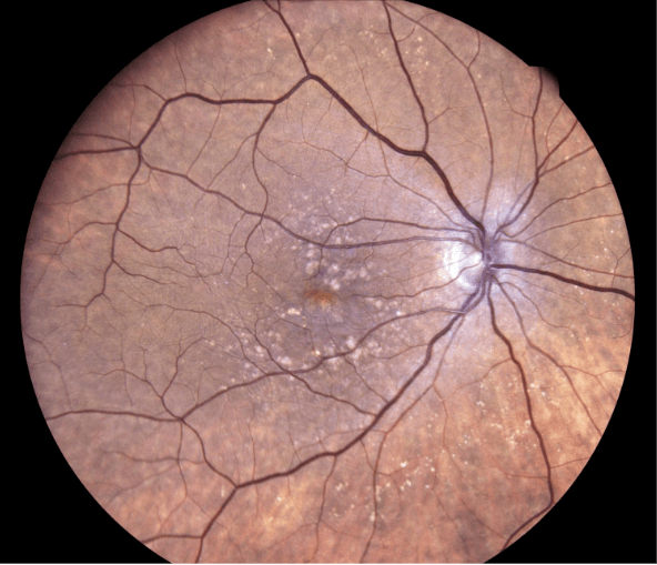 Baseline Fundus OD