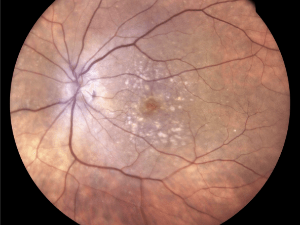 2 Year Fundus OS