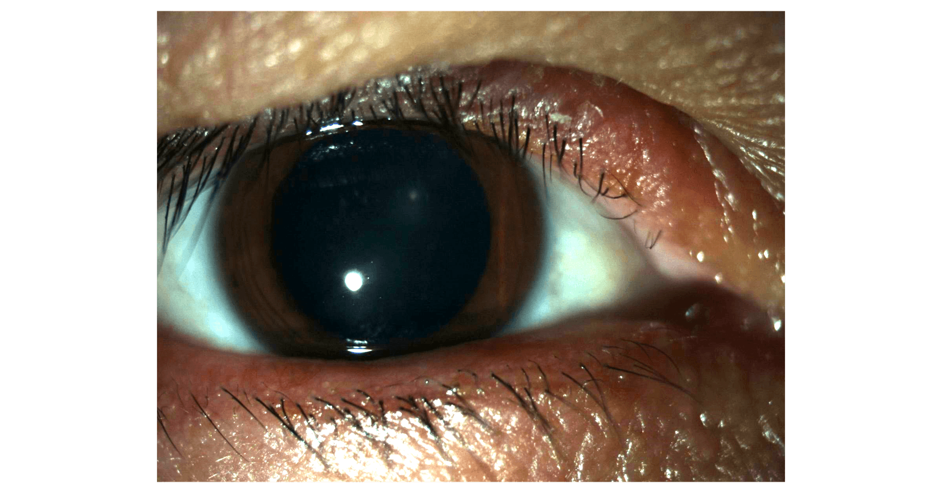 Seborrheic Blepharitis