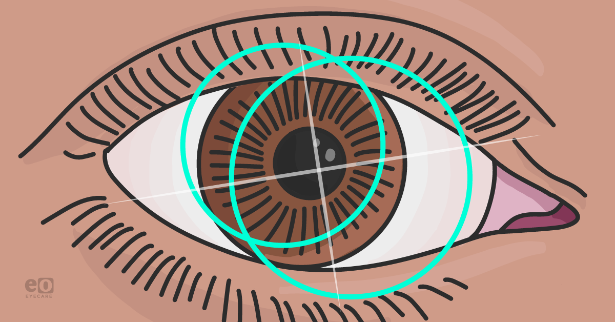 Soft Contact Lens Fitting for Astigmatic Patients