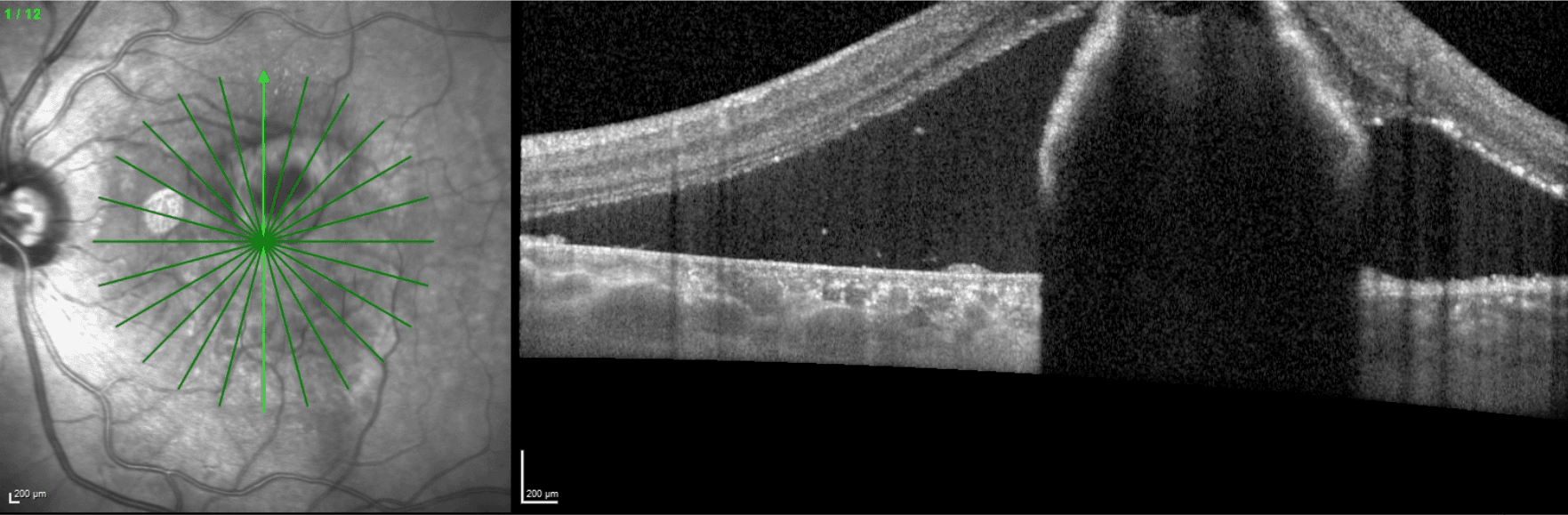 RPE Tear Baseline