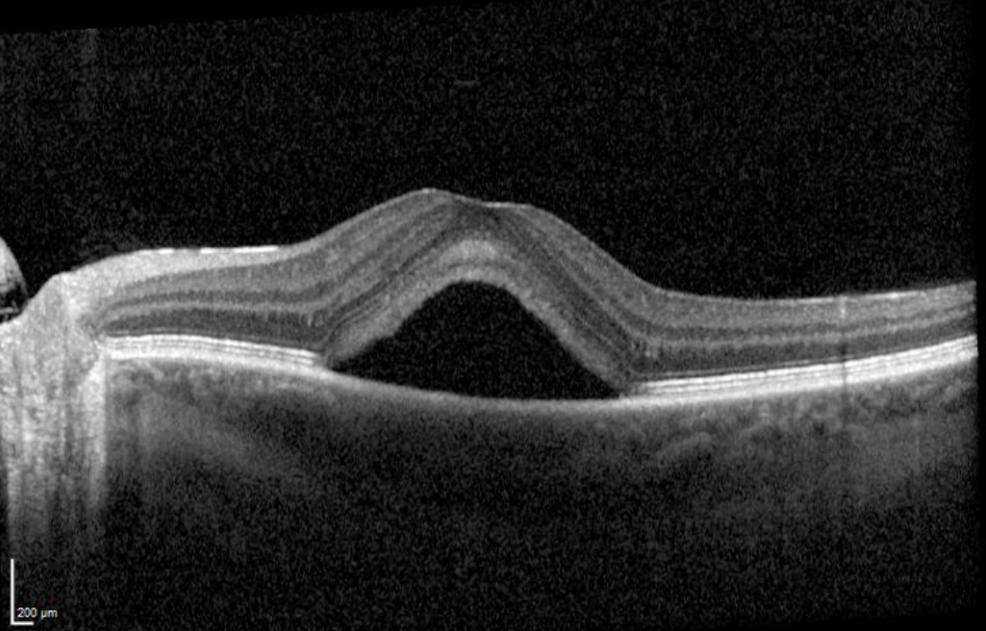 OCT Baseline