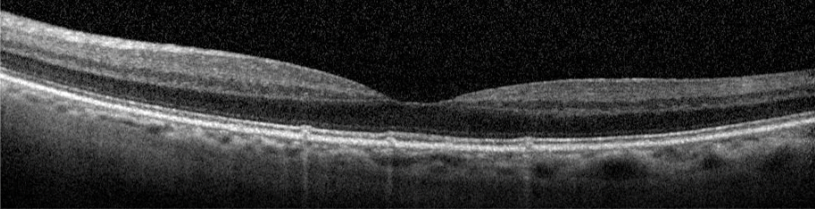 Optical coherence tomography (OCT) imaging of the patient's left eye from 12 years ago that shows a relatively health retina.