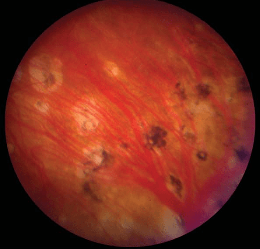 sympathetic ophthalmia