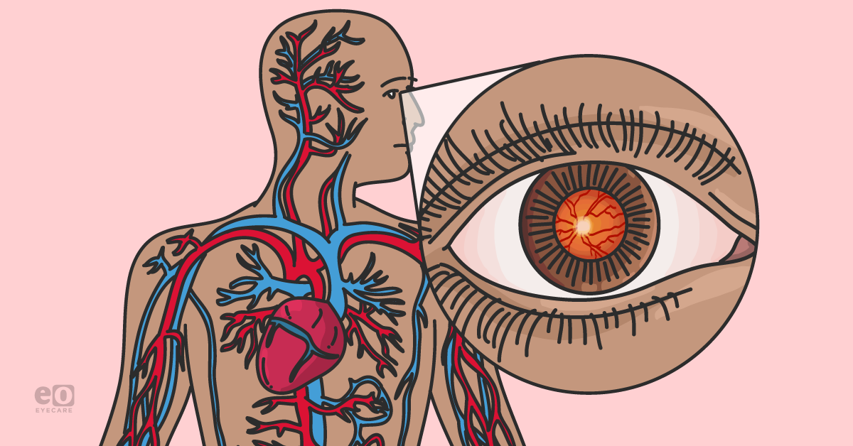 Ocular Manifestations of Systemic Infections: A Concise Overview