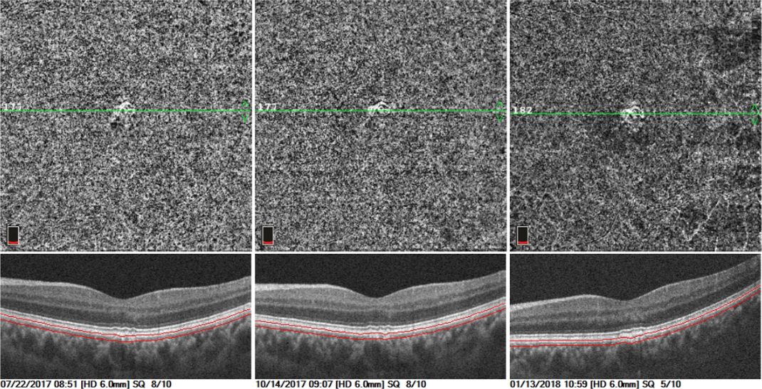 OCTA MultiScan View Membrane