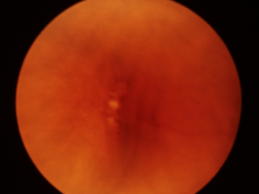 Cobblestone Degeneration Fundus