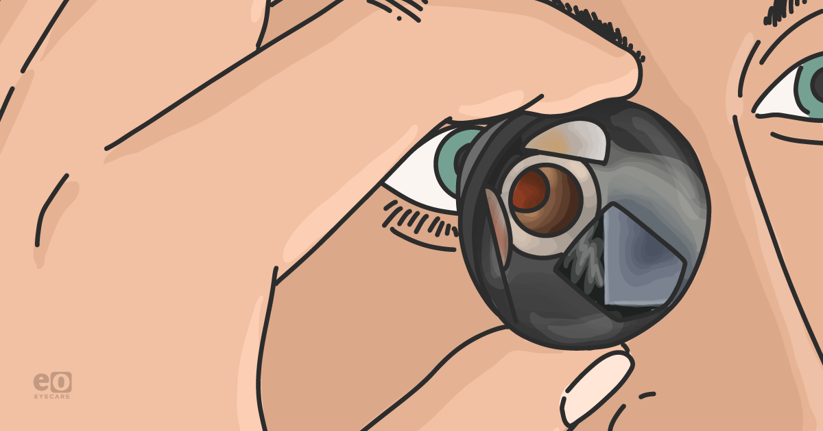 Diagnosis and Management of Pseudoexfoliation Glaucoma