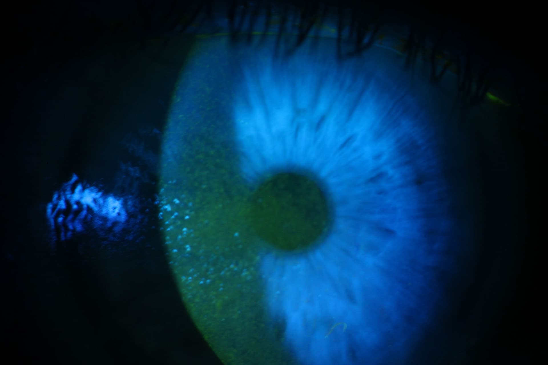 Slit lamp photograph of corneal staining caused by dry eye disease (DED).