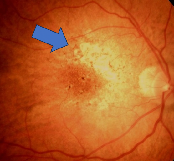 Color fundus photograph (CFP) of the right eye at baseline, it shows large demarcated areas of hypopigmentation caused by atrophic lesions from geographic atrophy (GA).