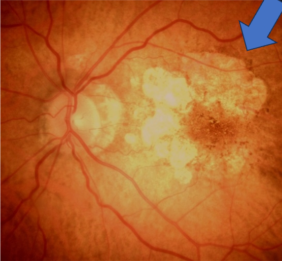 Color fundus photograph (CFP) of the left eye at baseline, it shows large demarcated areas of hypopigmentation caused by atrophic lesions from geographic atrophy (GA).