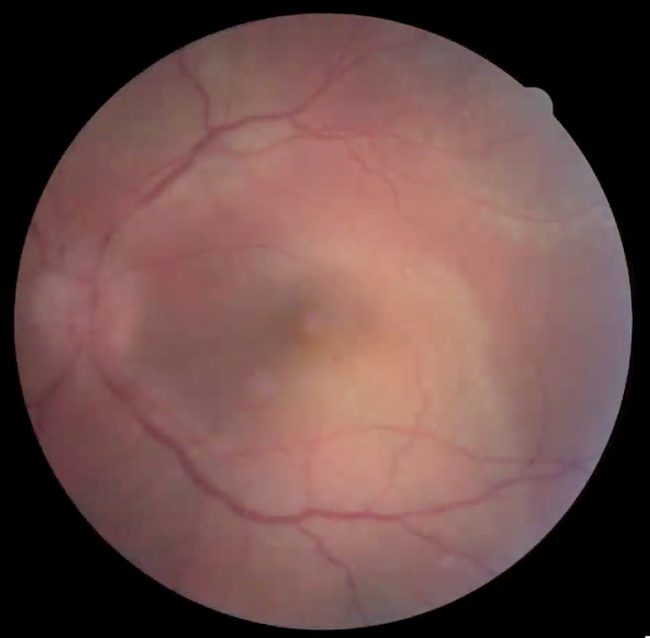 Corticosteroid Fundus OS
