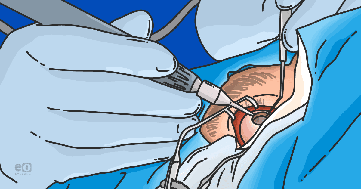 3 Major Complications in Vitreoretinal Surgery Residents/Fellows Should Know