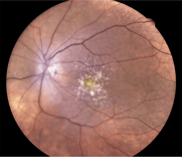 Baseline Fundus OS