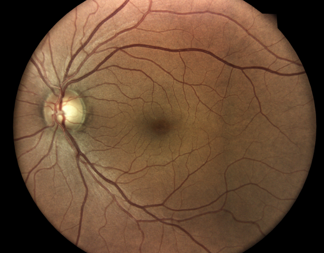 Baseline Fundus OS