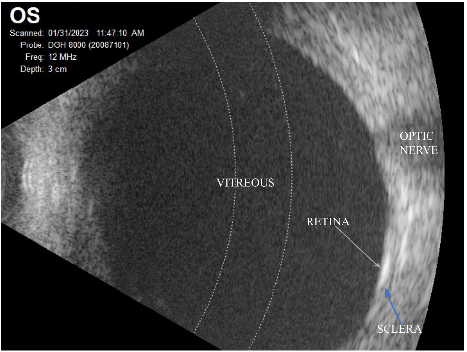 B-Scan Ultrasonography