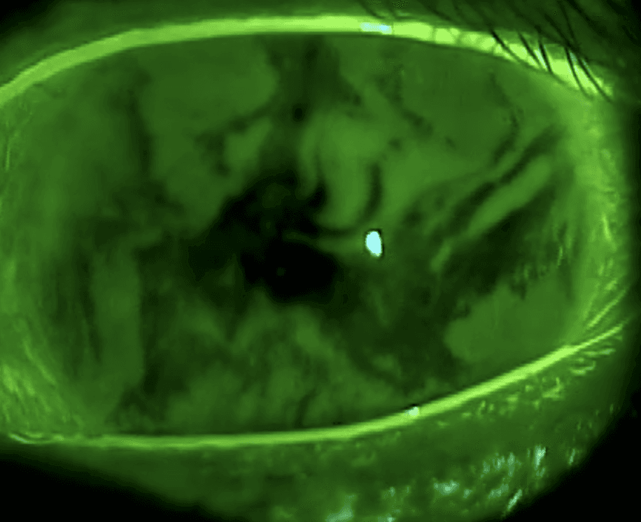 Fluorescein breakup pattern