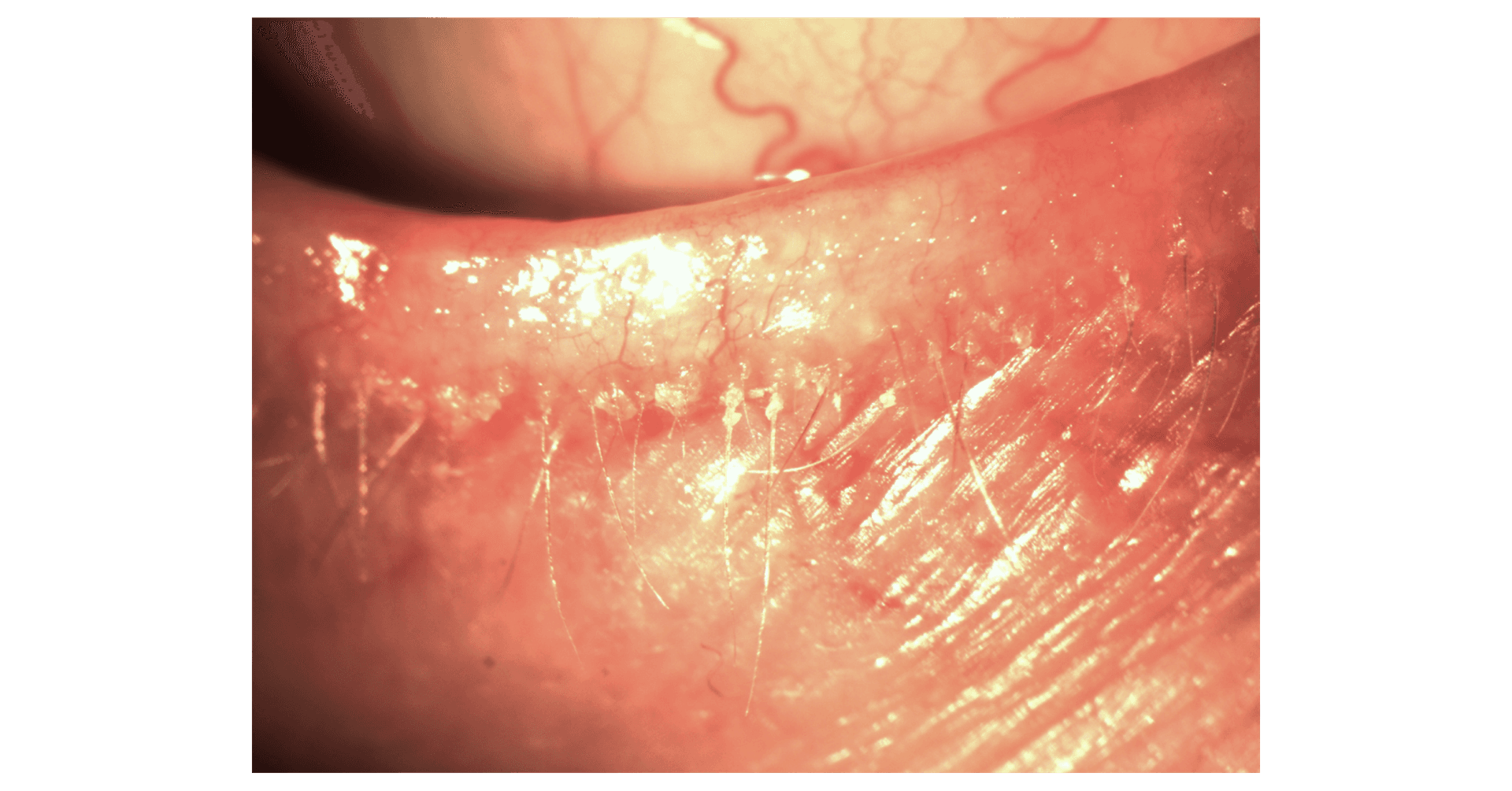 Seborrheic Blepharitis