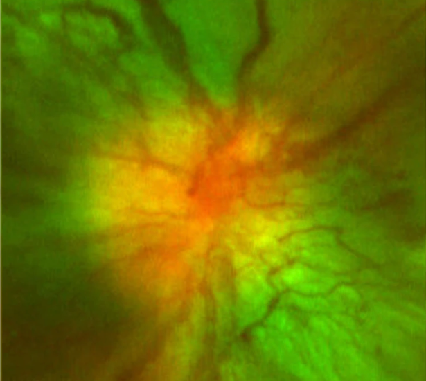 Fundus Diabetic Papillopathy