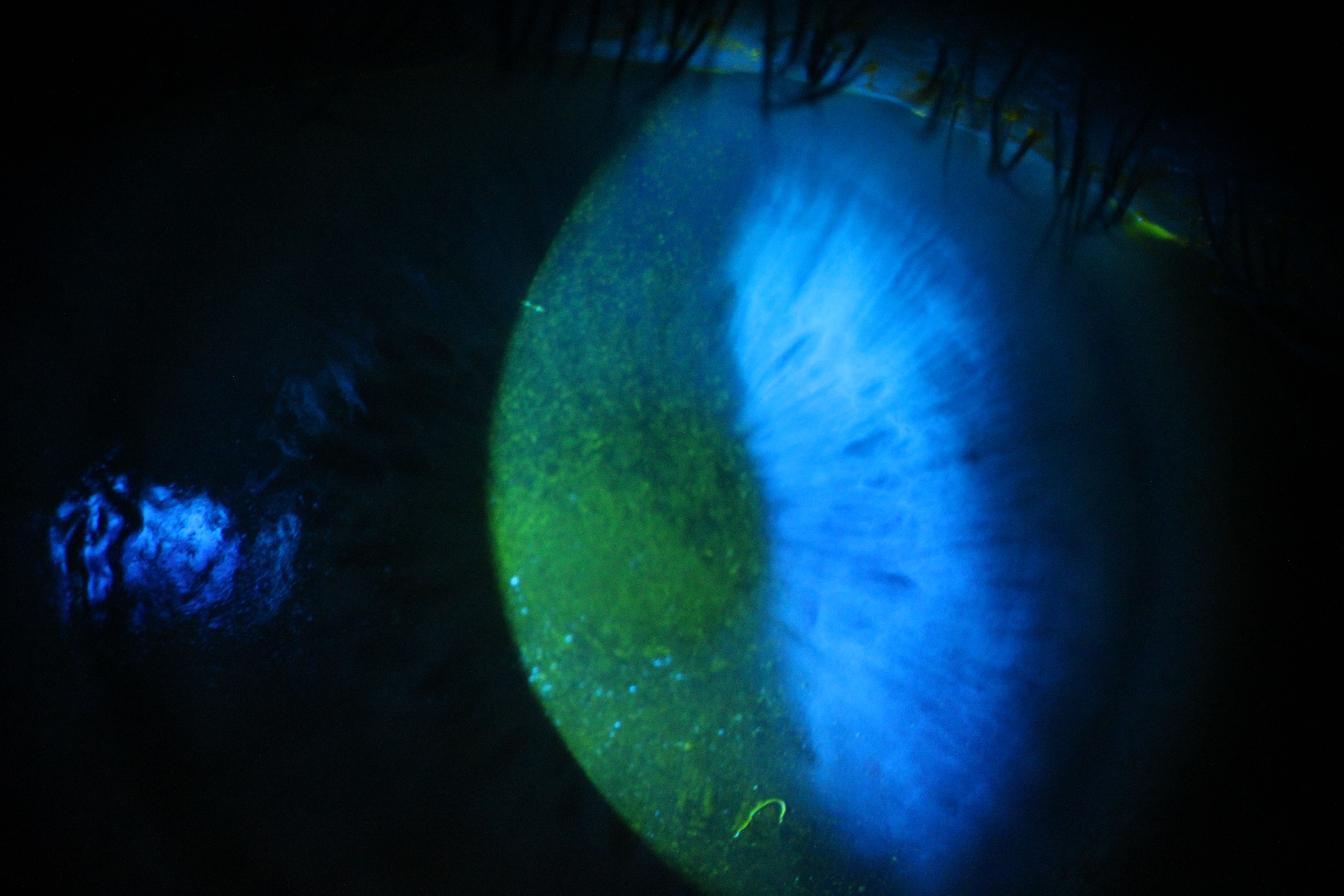 Slit lamp photograph of corneal staining caused by dry eye disease (DED)