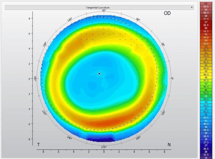 Ortho-k Lens After