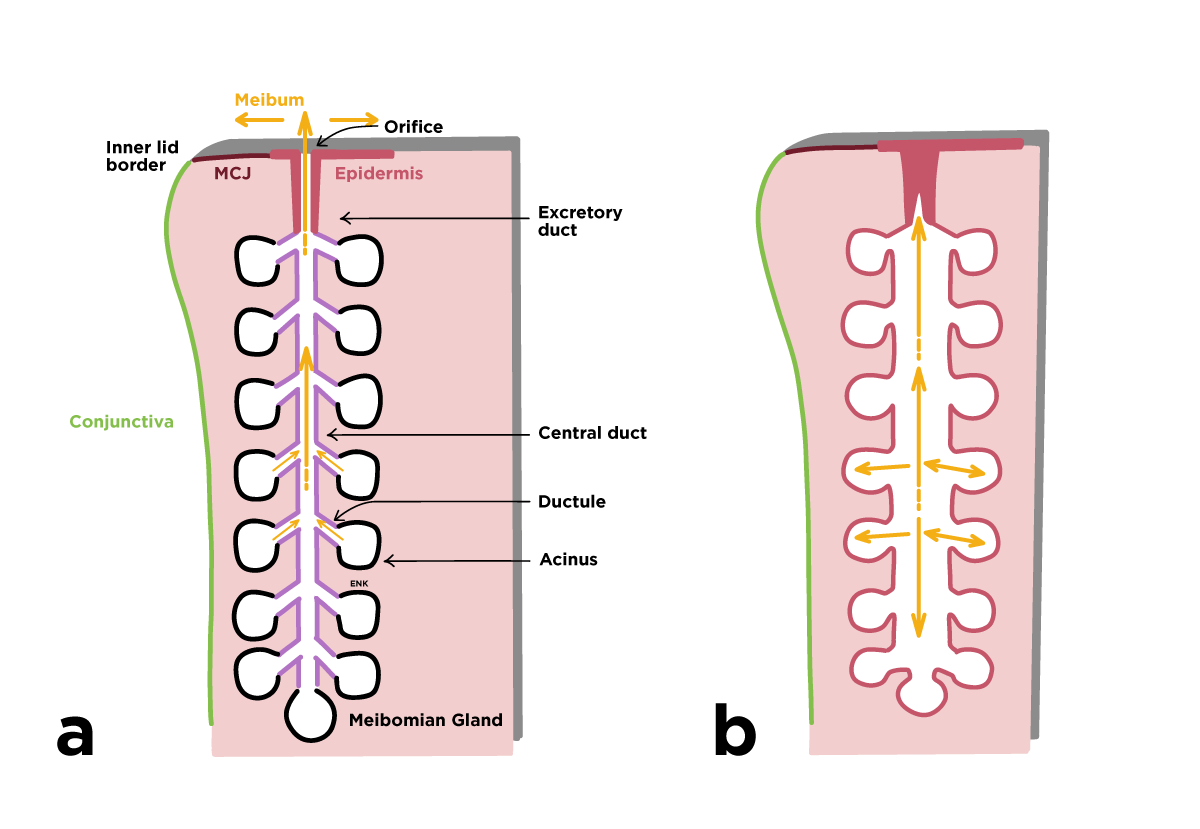 Healthy vs unhealthy meibomian gland