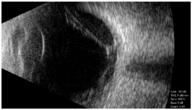 Tractional Detachment Dynamic B-Scan