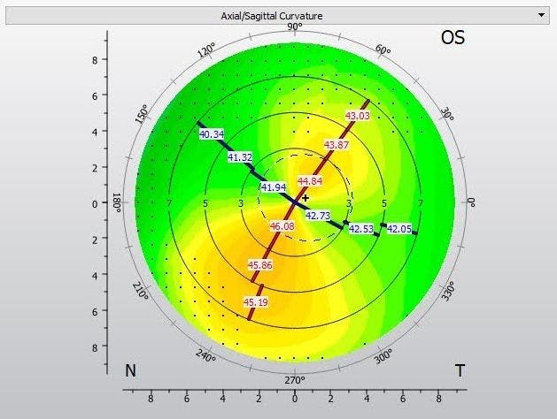 Corneal topography oblique astigmatism