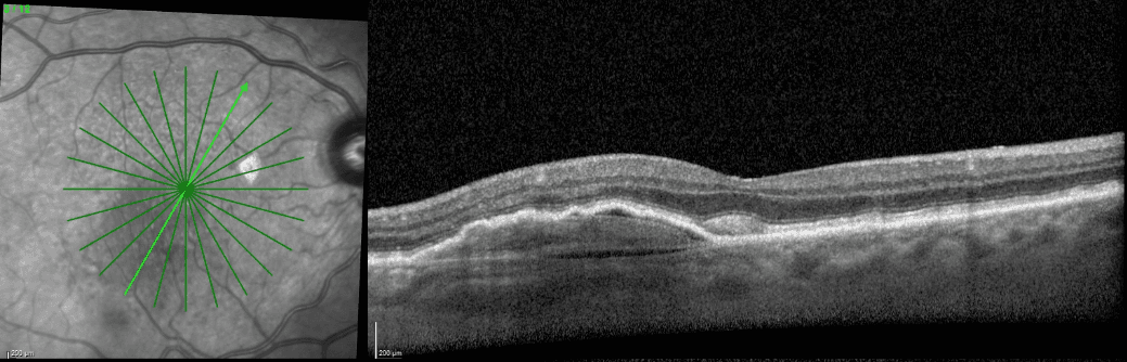 Vascularized PED anti-VEGF