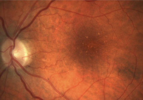 Color fundus photograph (CFP) of the patient's left eye from 12 years ago, showing the presence of drusen.