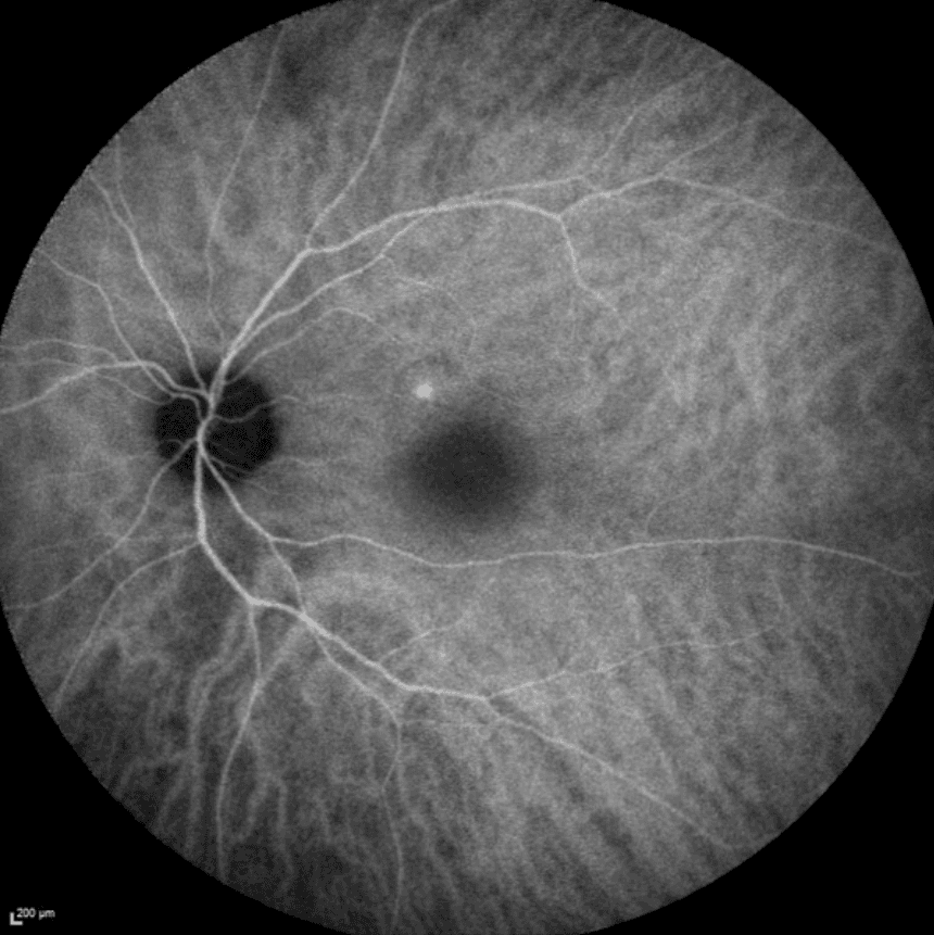 ICG Angiography 6 months