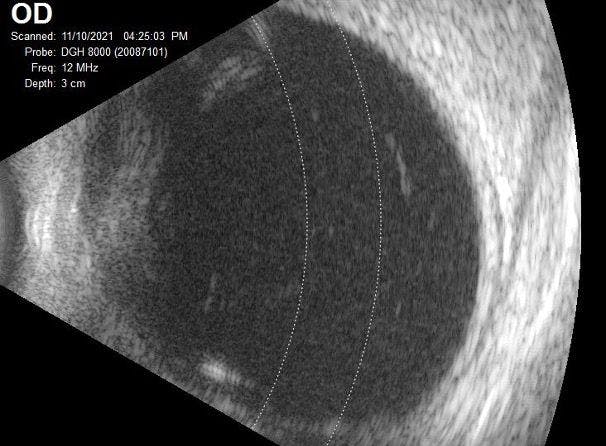 Vitreous Degeneration B-scan