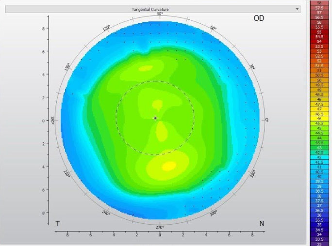 Ortho-k Lens Before