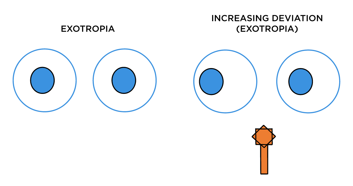 Convergence testing exotropia