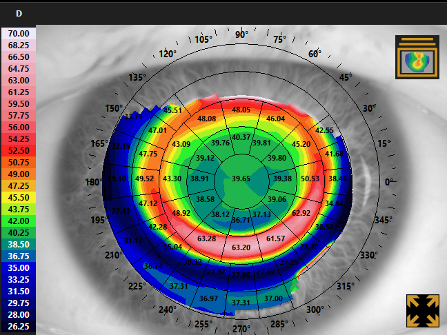 Corneal topography