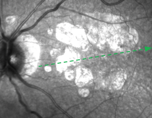 Near-infrared reflectance (NIR) imaging of the patient's left eye, geographic atrophy (GA) lesions show up as hyperreflective on NIR imaging.