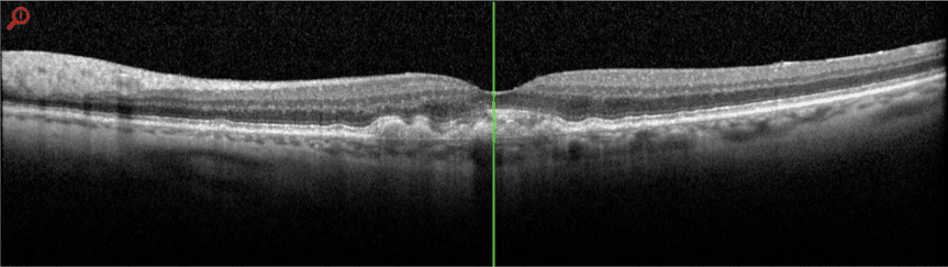 Baseline OCT OS