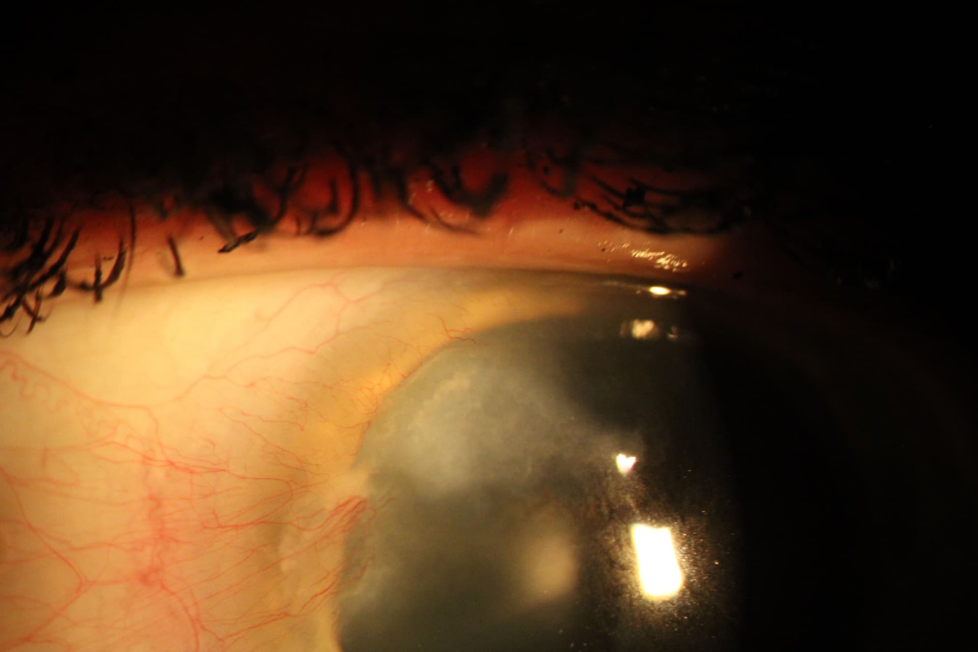 Slit lamp image of Salzmann nodules.