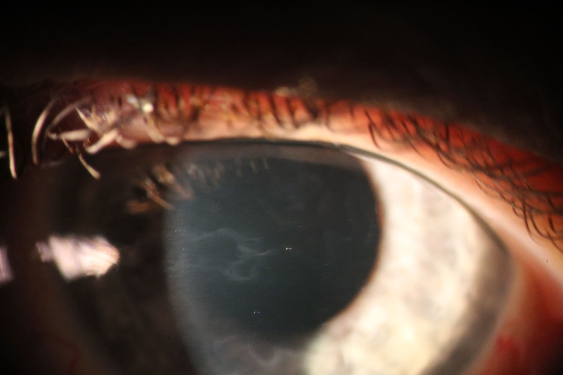 Slit lamp image of anterior basement membrane dystrophy (ABMD).