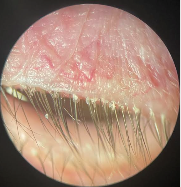 Demodex blepharitis collarettes