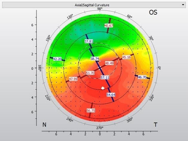 Corneal topography irregular astigmatism