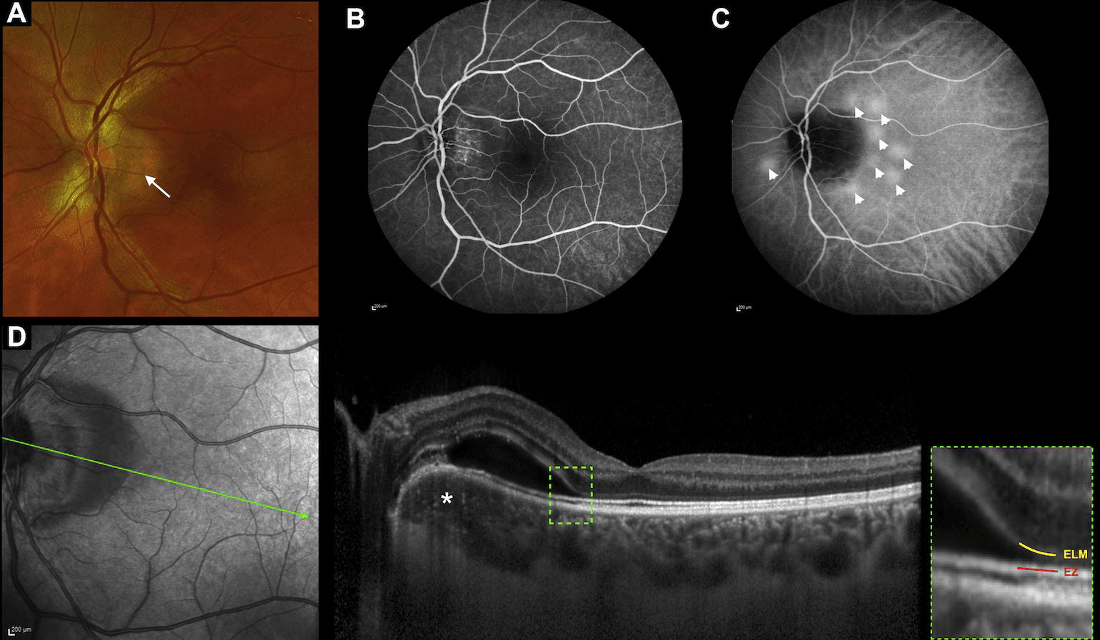 Peripapillary pachychoroid syndrome