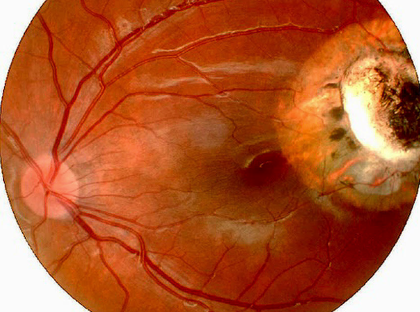 Central Retinoblastoma