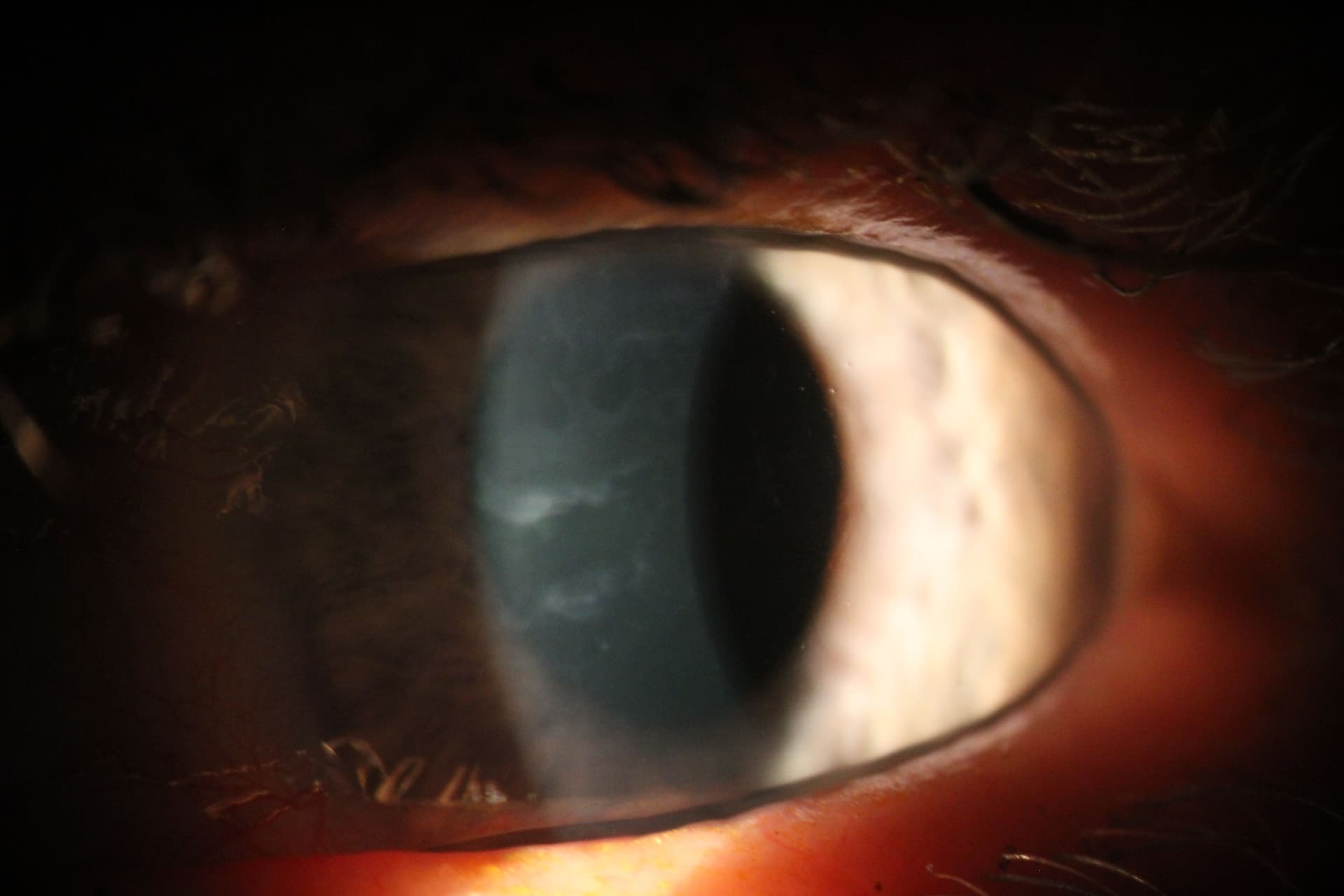 Slit lamp photograph of anterior basement membrane dystrophy (ABMD).