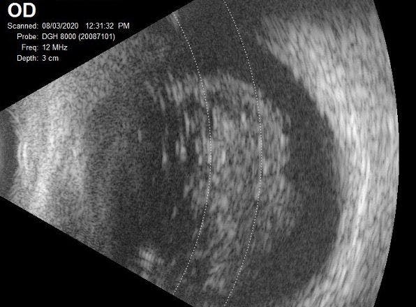 Asteroid Hyalosis B-Scan