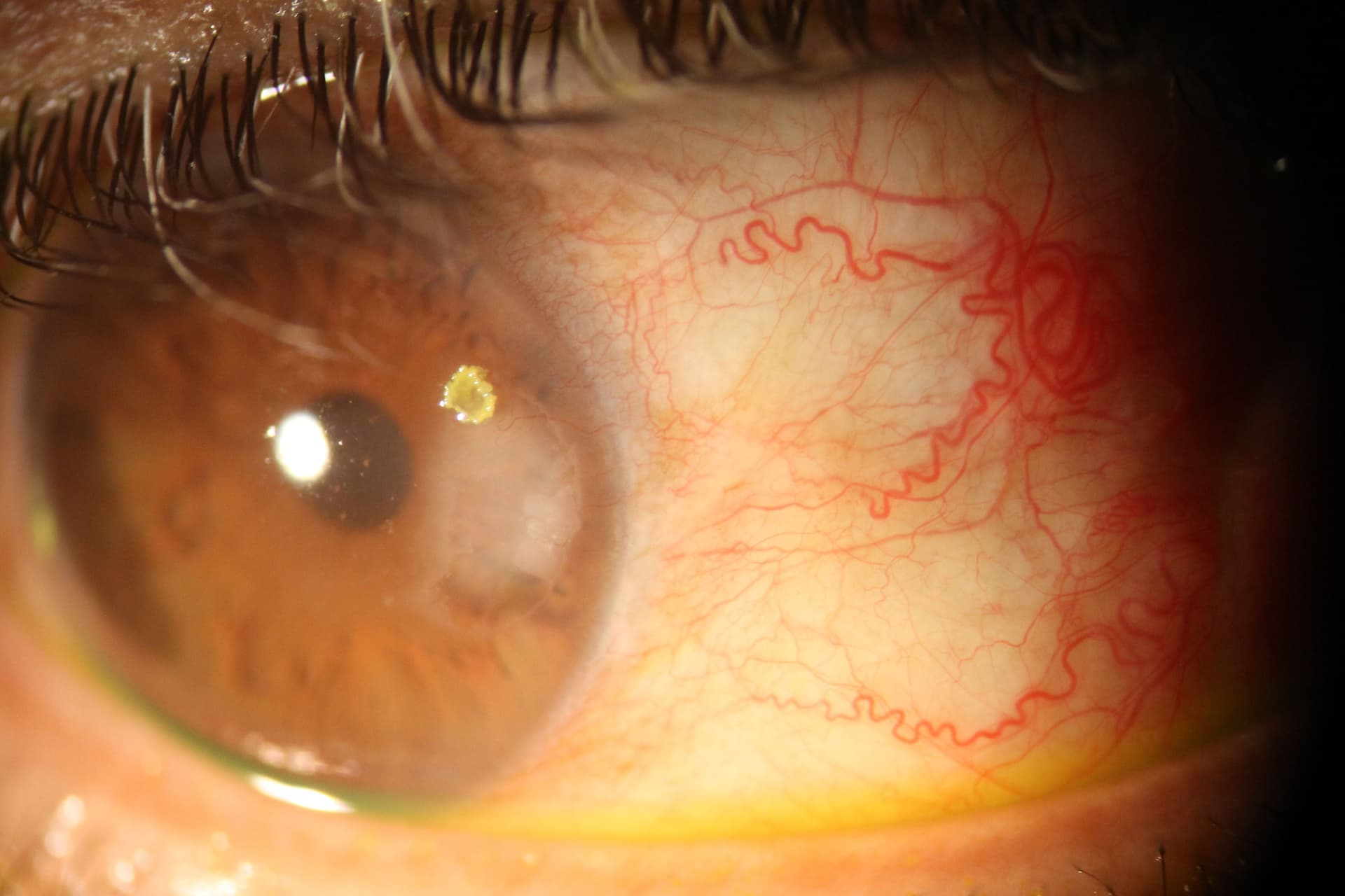 Slit lamp image of Salzmann nodules.