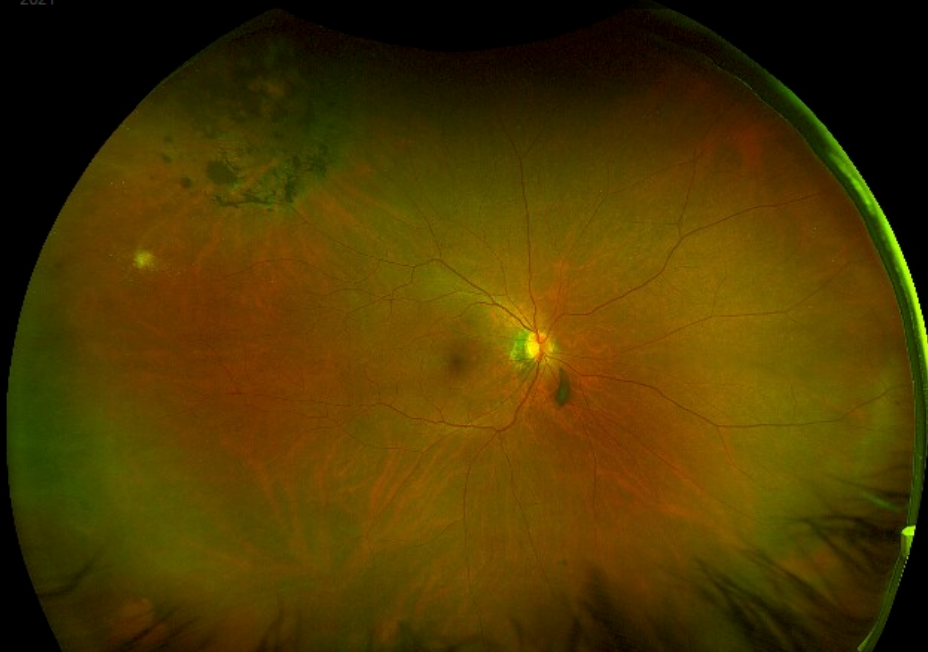 Retinal Tear