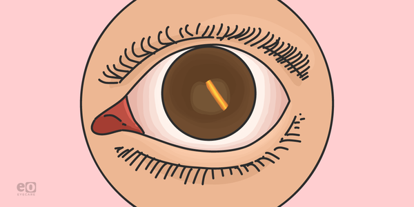 Intravitreal Corticosteroid Implants: What You Need to Know